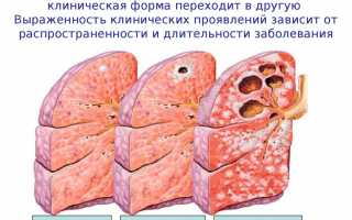 Как проявляется туберкулез у взрослых: признаки и симптомы болезни